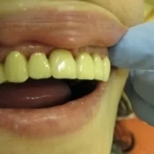 Протезирование зубов на дому у пациента